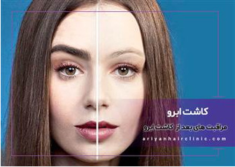 مراقبت های بعد از کاشت ابرو